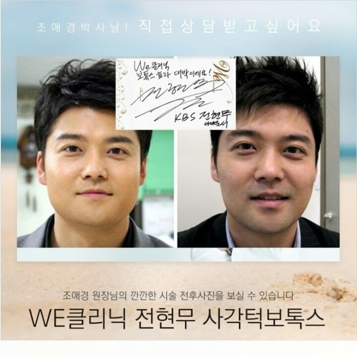 전현무 턱보톡스 전후 | 인스티즈