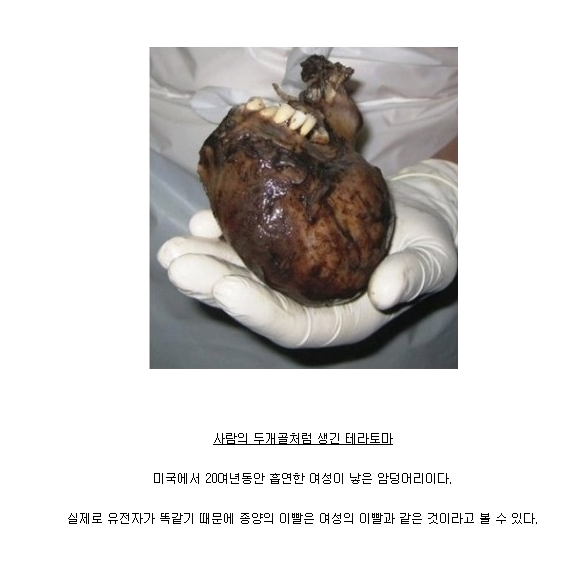 사람을 닮은 기괴한 암덩어리 테라토마 *혐오주의 | 인스티즈