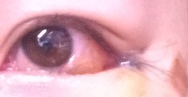 눈꼬리내리기뒤트임하고 인생 제대로 망할 뻔 했습니다.*혐오주의 | 인스티즈