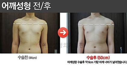 어좁 남자들의 마지막 희망 어깨 성형.jpg | 인스티즈