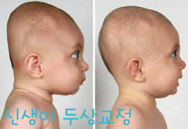 심각한 두상변형때문에 두상교정기를 끼는 아이들..jpg | 인스티즈