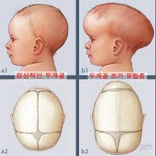 심각한 두상변형때문에 두상교정기를 끼는 아이들..jpg | 인스티즈