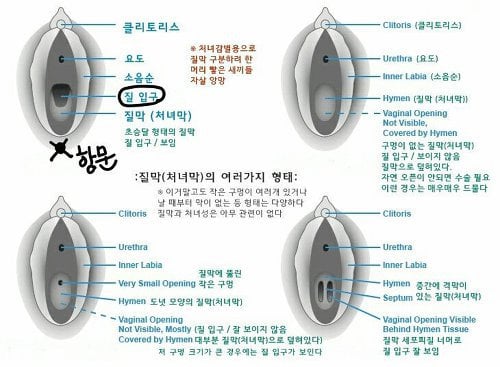 질막(처녀막)에 대해 넌 어디까지 알고있니? | 인스티즈