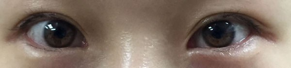 눈꼬리내리기뒤트임하고 인생 제대로 망할 뻔 했습니다.*혐오주의 | 인스티즈