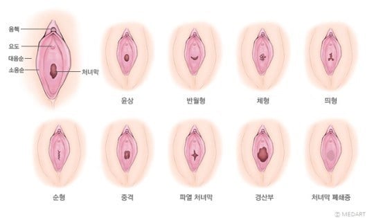 질막(처녀막)에 대해 넌 어디까지 알고있니? | 인스티즈