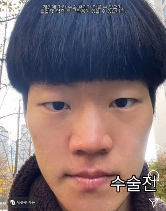 남자 성형 전후 절개눈교+코+윤곽3종+양악 | 인스티즈