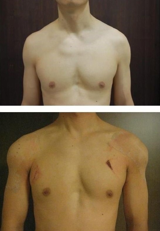 어좁 남자들의 마지막 희망 어깨 성형.jpg | 인스티즈