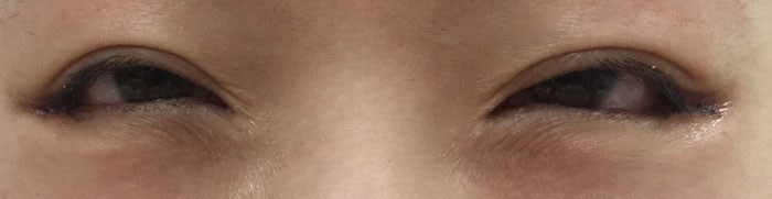 눈꼬리내리기뒤트임하고 인생 제대로 망할 뻔 했습니다.*혐오주의 | 인스티즈