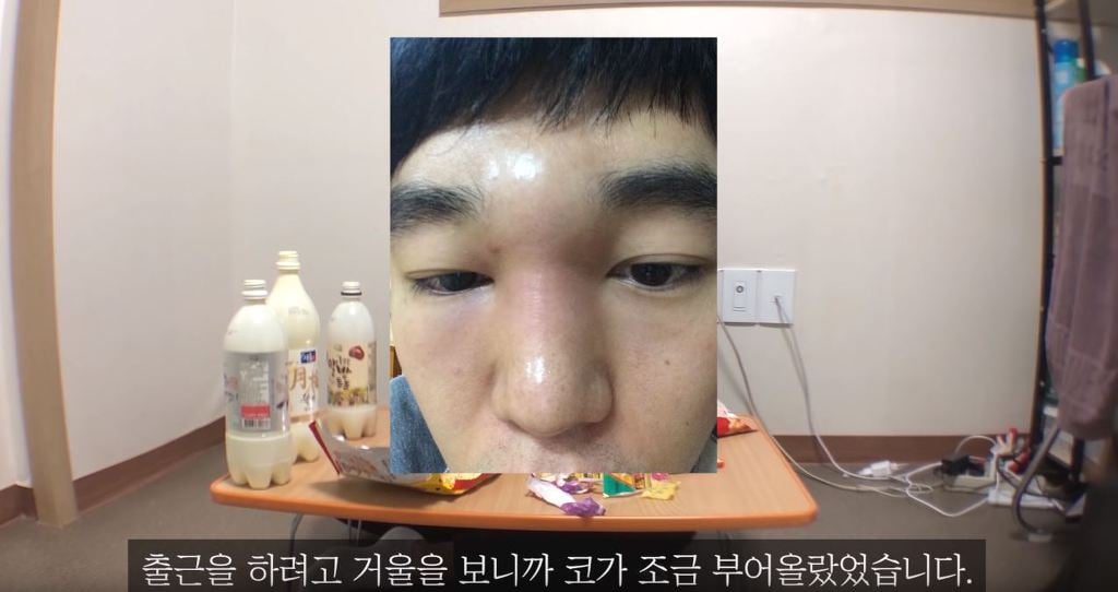 코성형 6년차에 부작용 일어난 이야기.jpg | 인스티즈