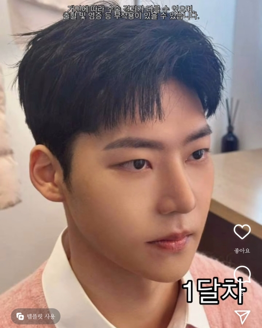 남자 성형 전후 절개눈교+코+윤곽3종+양악 | 인스티즈