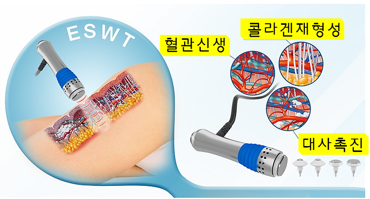 체외충격파 시술의 시작된이유 | 인스티즈