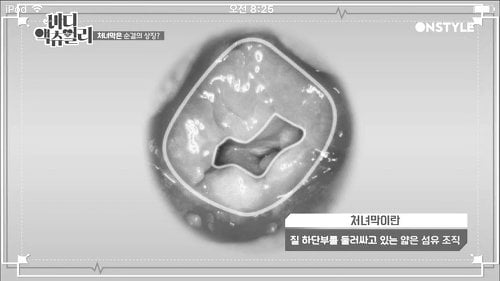 질막(처녀막)에 대해 넌 어디까지 알고있니? | 인스티즈