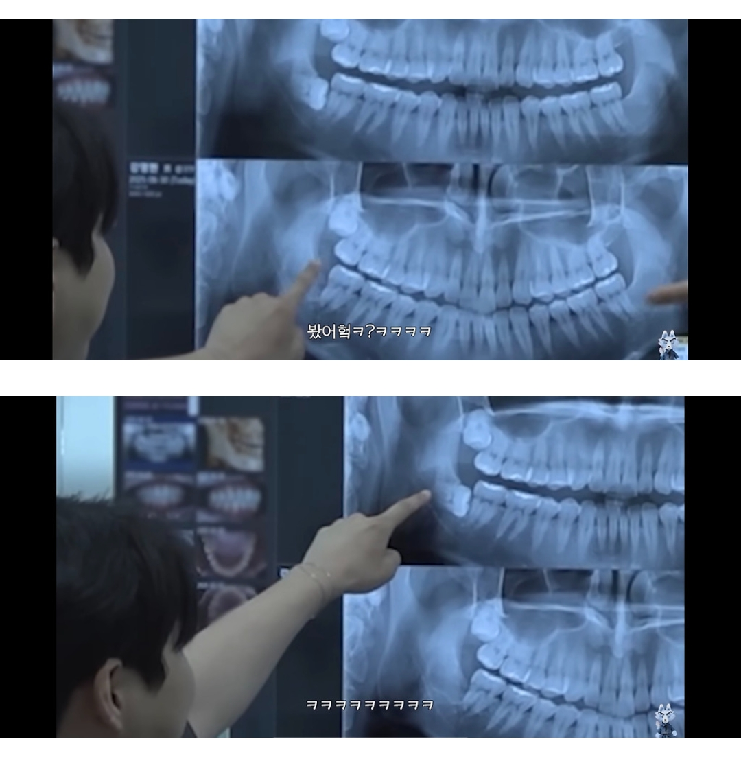 영케이 대단한 사랑니 | 인스티즈