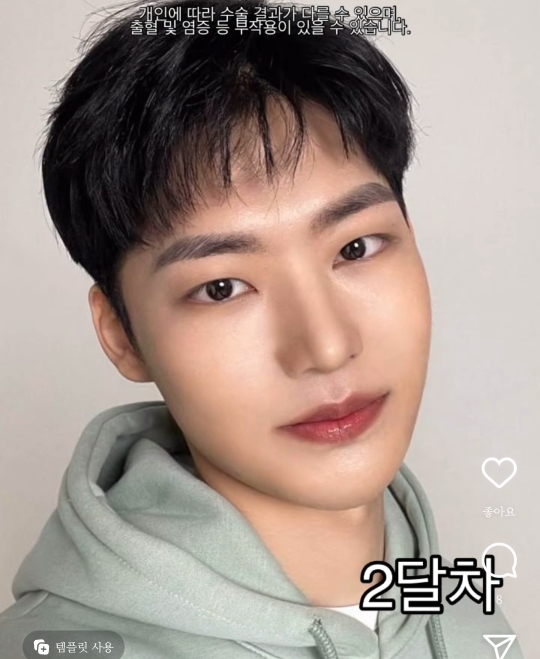 남자 성형 전후 절개눈교+코+윤곽3종+양악 | 인스티즈
