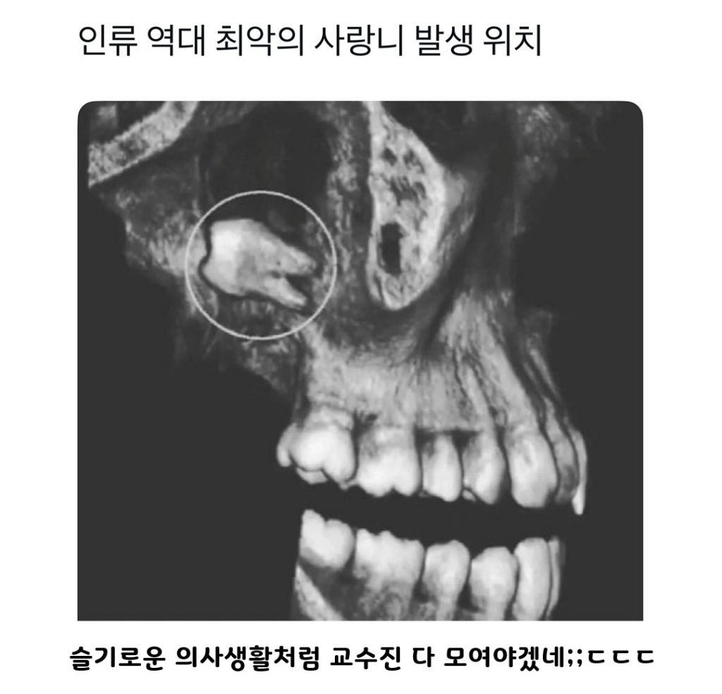 인류 역대 최악의 사랑니 위치 | 인스티즈