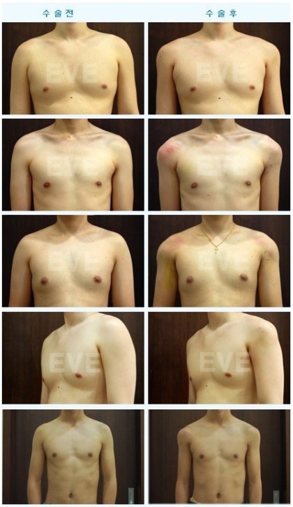 어좁 남자들의 마지막 희망 어깨 성형.jpg | 인스티즈