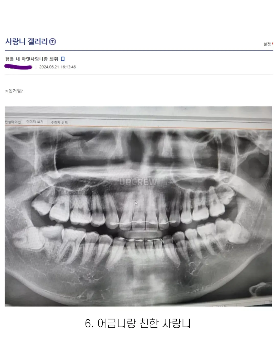 사랑니 갤러리의 특이한 사랑니들 (약혐 주의) | 인스티즈