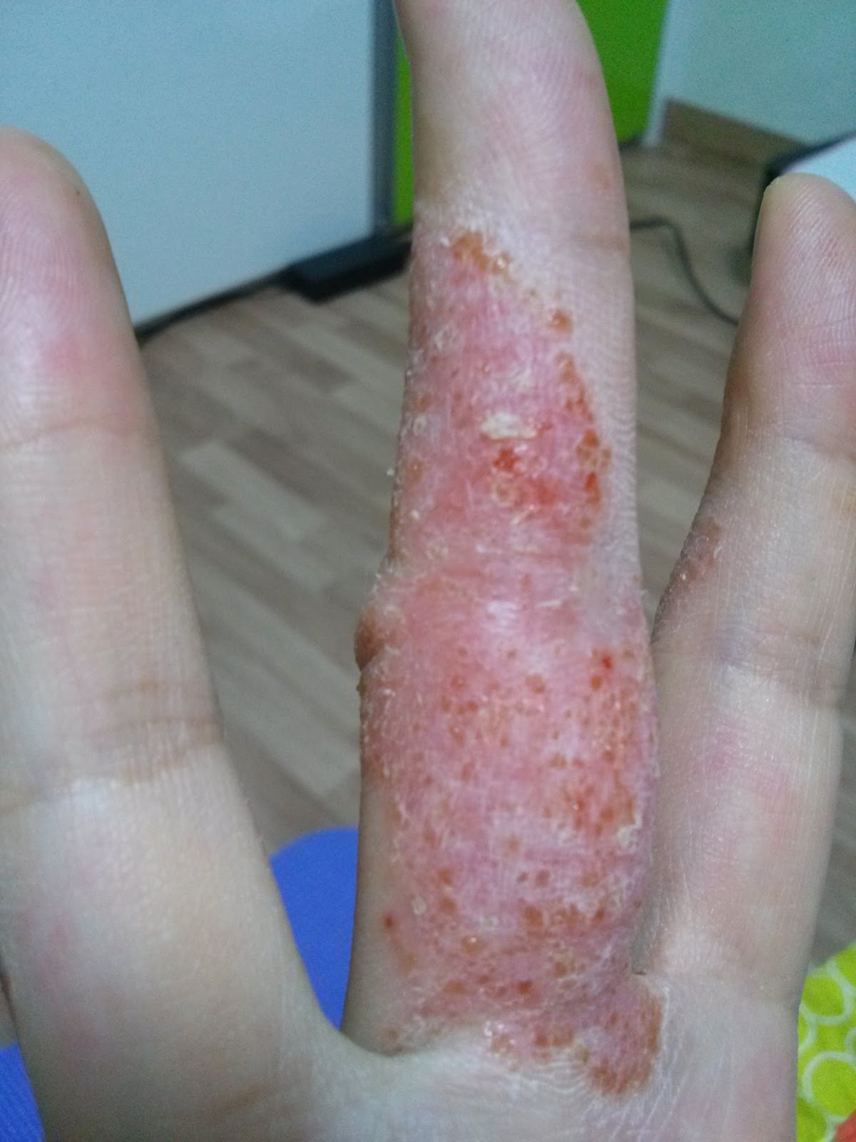 엄청 간지럽고 수포 올라오는 한포진 (약간 징그러울 수 있음 주의ㅠ) | 인스티즈