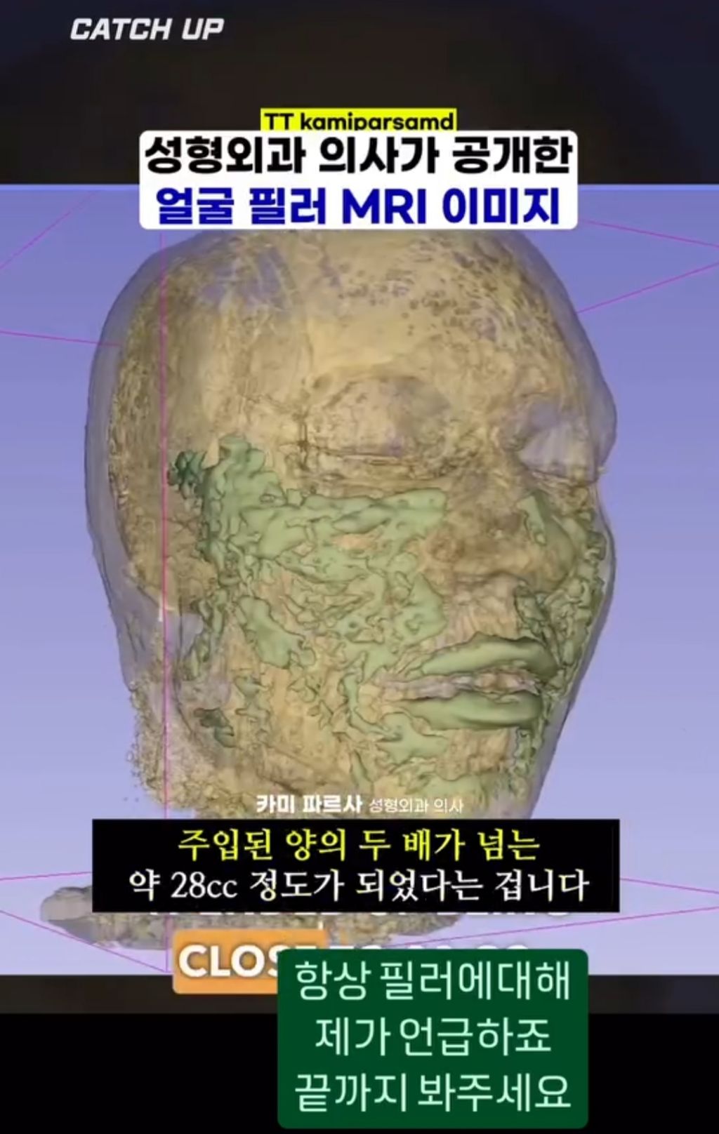 얼굴에 필러맞으면 얼굴 커짐.jpg | 인스티즈