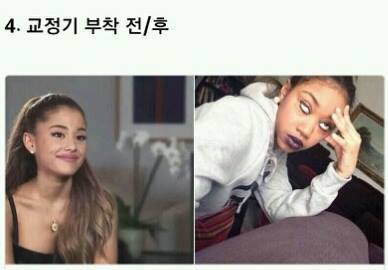해본 사람만 아는 치아교정의 고통 | 인스티즈