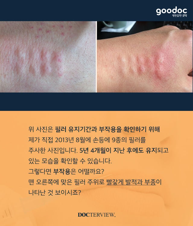필러를 자신의 손에 직접 주사한 의사, 5년 뒤... | 인스티즈