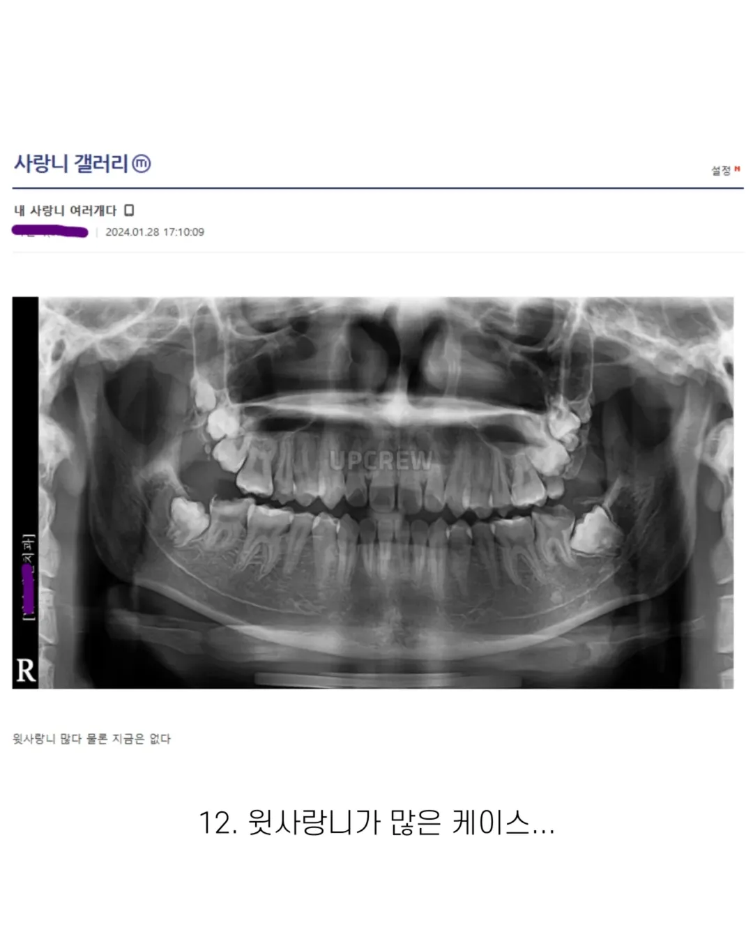 사랑니 갤러리의 특이한 사랑니들 (약혐 주의) | 인스티즈