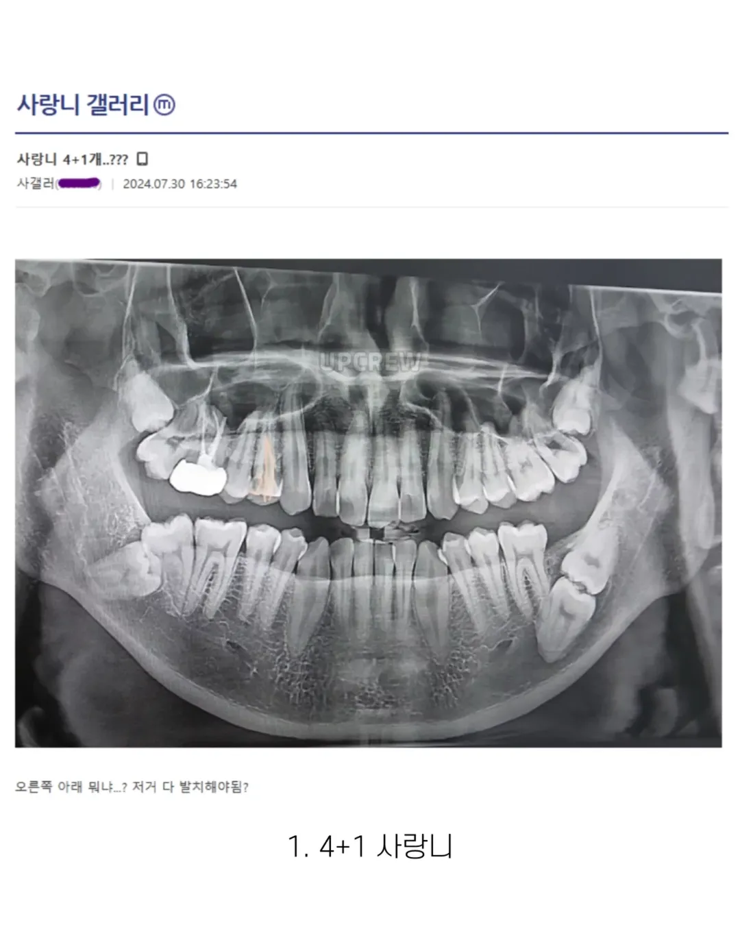 사랑니 갤러리의 특이한 사랑니들 (약혐 주의) | 인스티즈