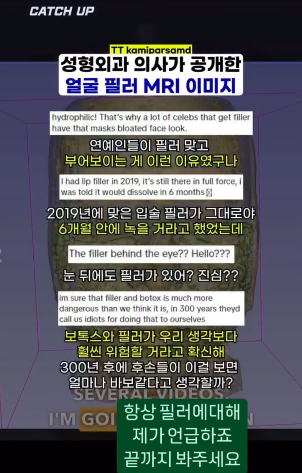 얼굴에 필러맞으면 얼굴 커짐.jpg | 인스티즈