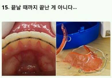 해본 사람만 아는 치아교정의 고통 | 인스티즈