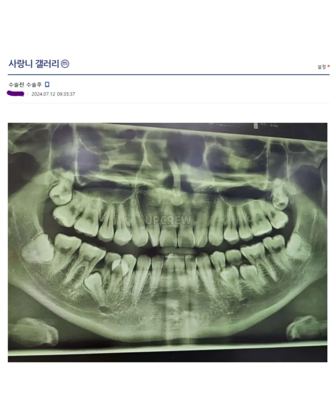 사랑니 갤러리의 특이한 사랑니들 (약혐 주의) | 인스티즈