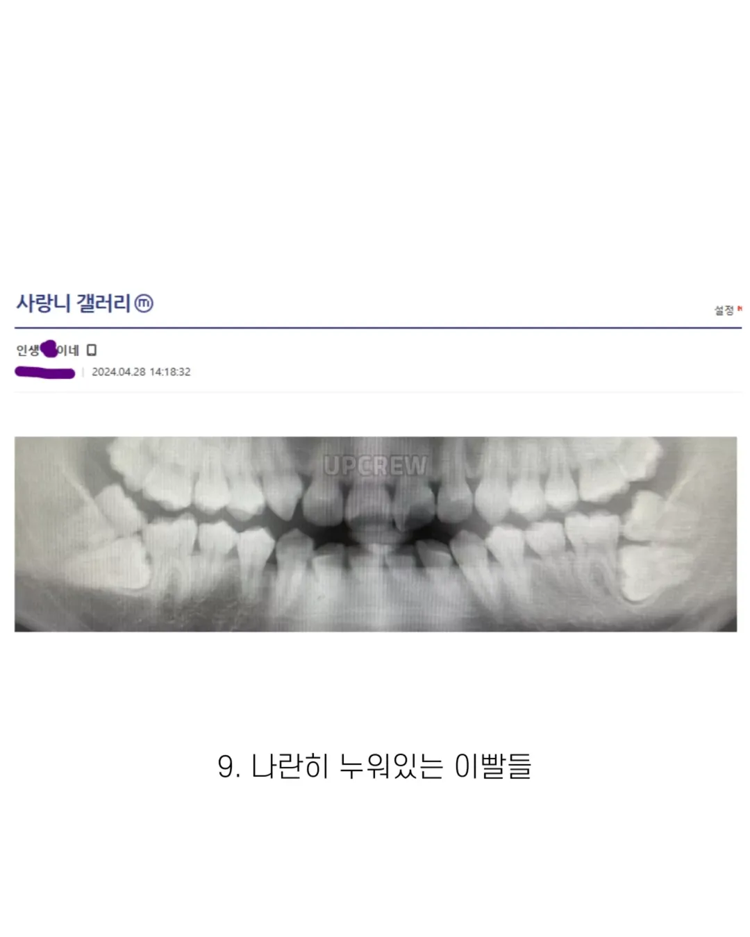 사랑니 갤러리의 특이한 사랑니들 (약혐 주의) | 인스티즈