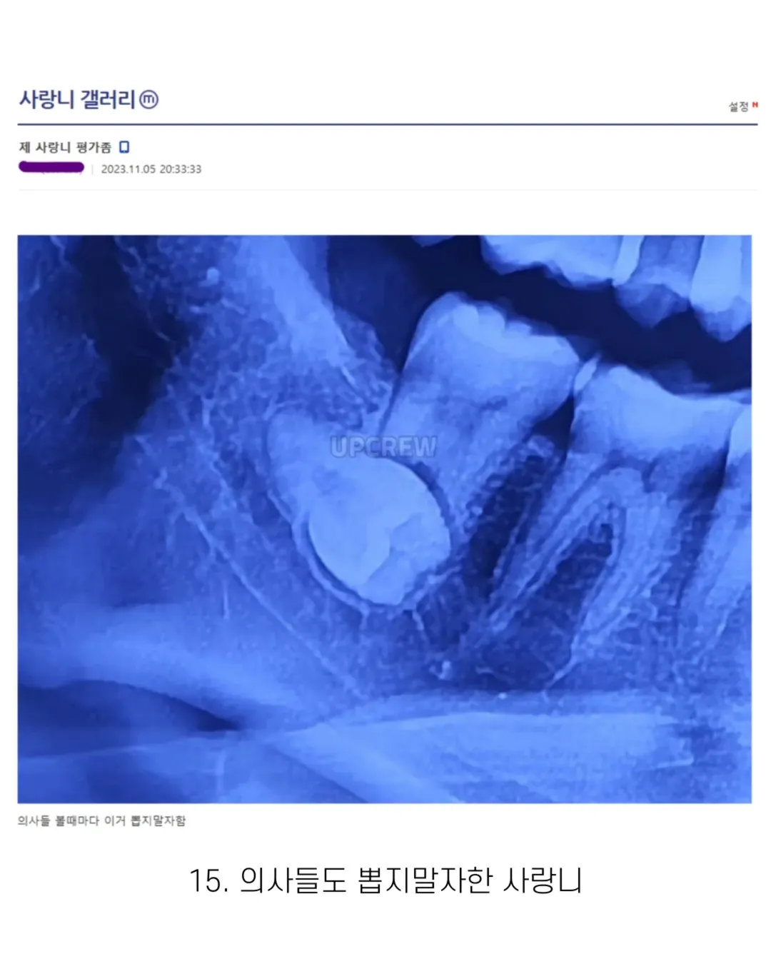 사랑니 갤러리의 특이한 사랑니들 (약혐 주의) | 인스티즈