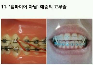 해본 사람만 아는 치아교정의 고통 | 인스티즈