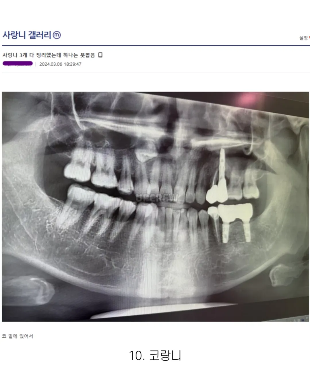 사랑니 갤러리의 특이한 사랑니들 (약혐 주의) | 인스티즈