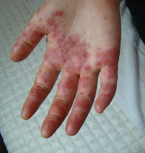 엄청 간지럽고 수포 올라오는 한포진 (약간 징그러울 수 있음 주의ㅠ) | 인스티즈