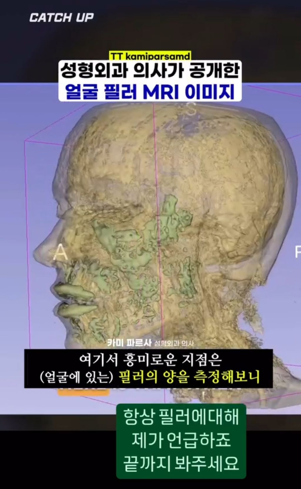 얼굴에 필러맞으면 얼굴 커짐.jpg | 인스티즈