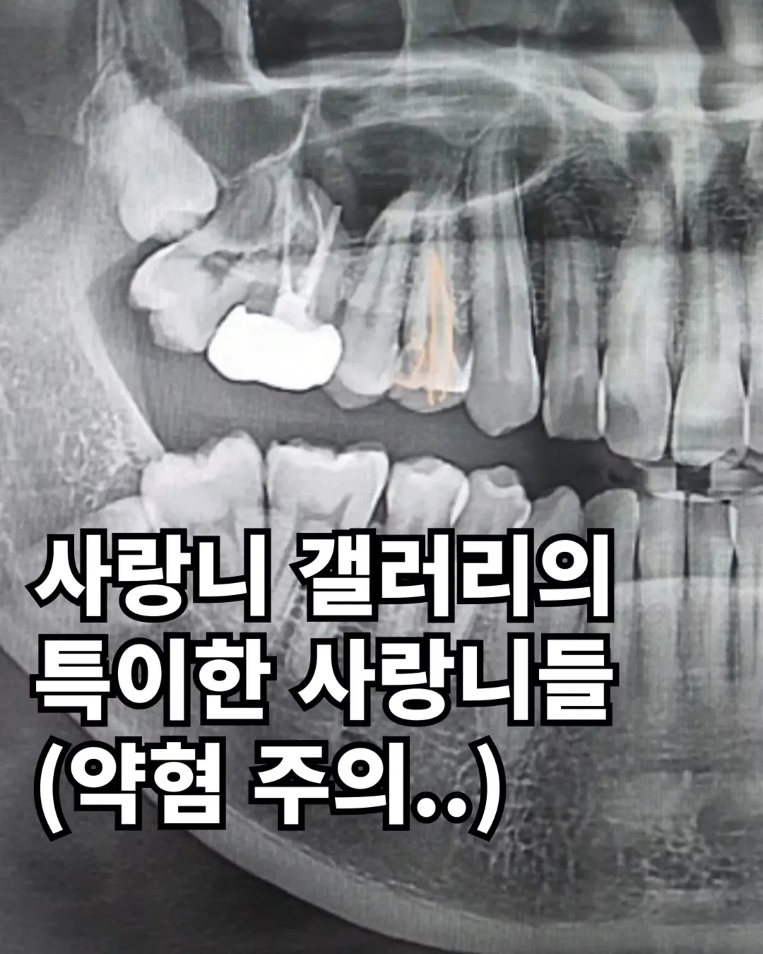 사랑니 갤러리의 특이한 사랑니들 (약혐 주의) | 인스티즈