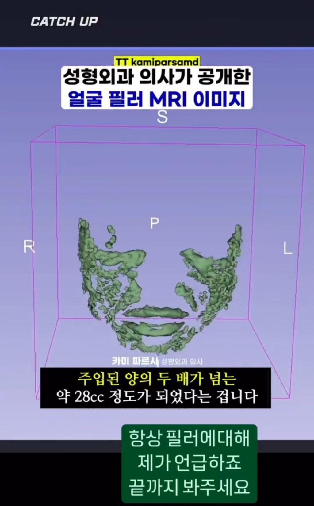 얼굴에 필러맞으면 얼굴 커짐.jpg | 인스티즈