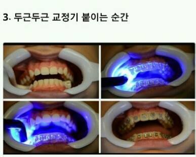 해본 사람만 아는 치아교정의 고통 | 인스티즈