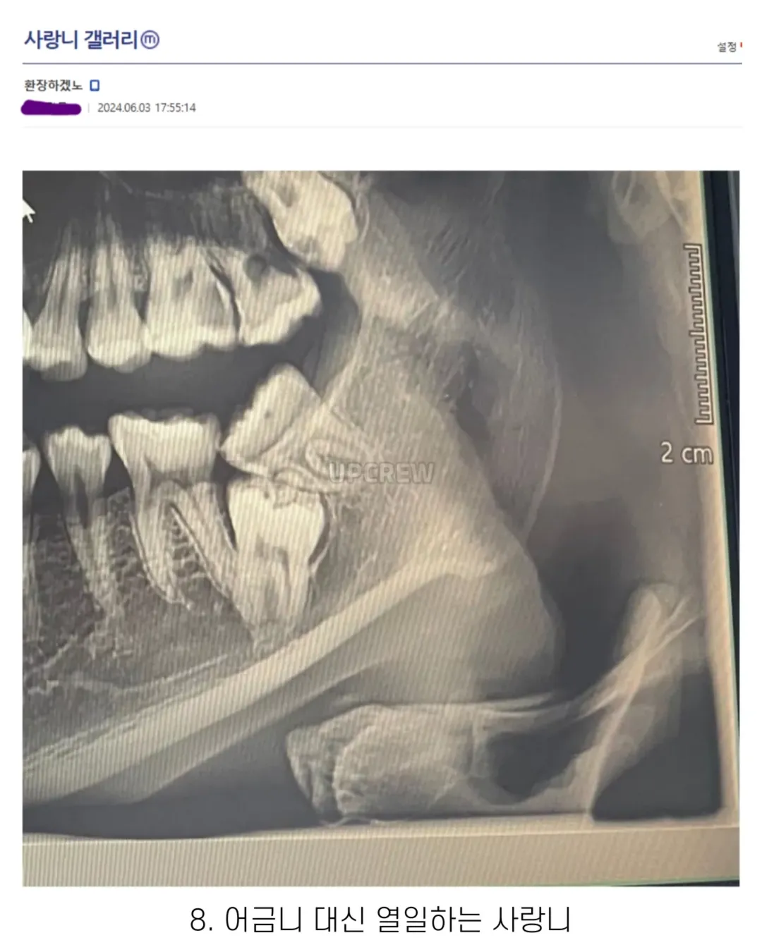 사랑니 갤러리의 특이한 사랑니들 (약혐 주의) | 인스티즈