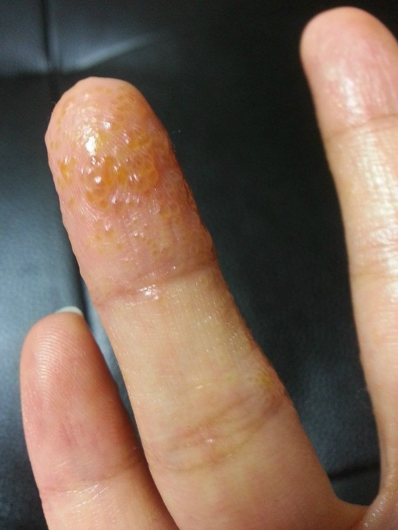 엄청 간지럽고 수포 올라오는 한포진 (약간 징그러울 수 있음 주의ㅠ) | 인스티즈