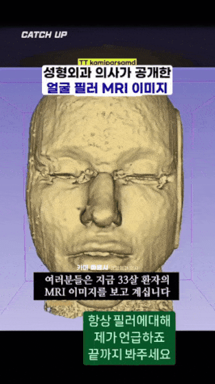 얼굴에 필러맞으면 얼굴 커짐.jpg | 인스티즈