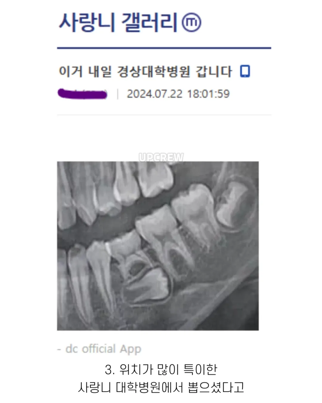 사랑니 갤러리의 특이한 사랑니들 (약혐 주의) | 인스티즈