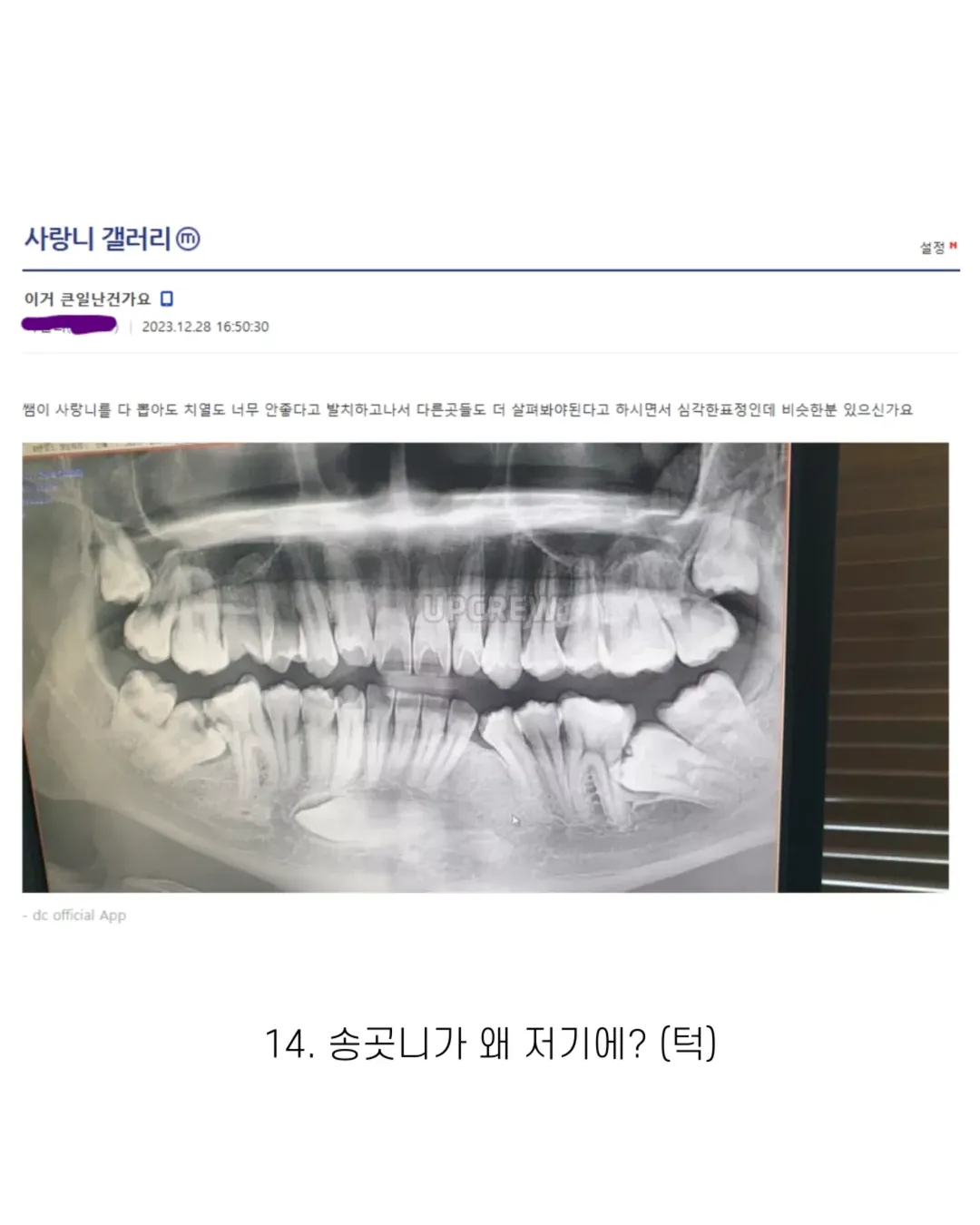 사랑니 갤러리의 특이한 사랑니들 (약혐 주의) | 인스티즈