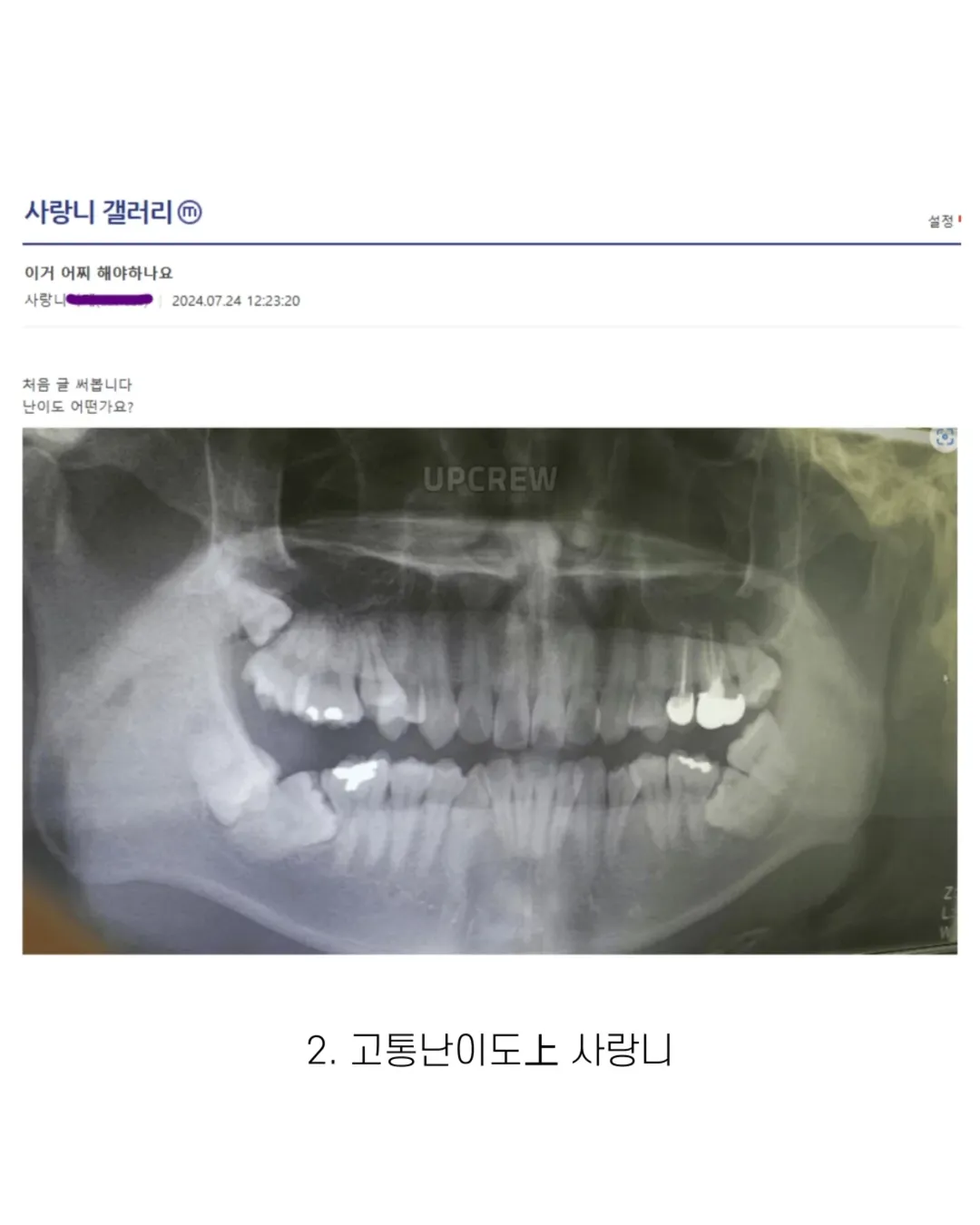 사랑니 갤러리의 특이한 사랑니들 (약혐 주의) | 인스티즈
