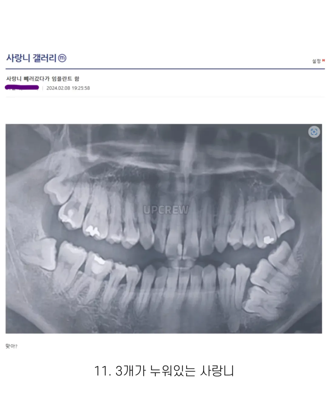 사랑니 갤러리의 특이한 사랑니들 (약혐 주의) | 인스티즈