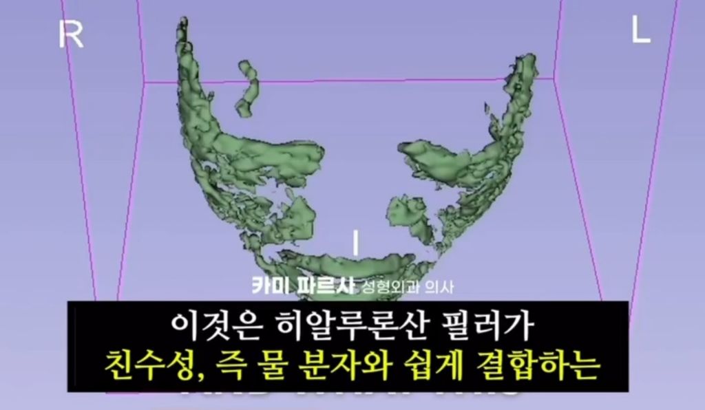 얼굴에 필러맞으면 얼굴 커짐.jpg | 인스티즈