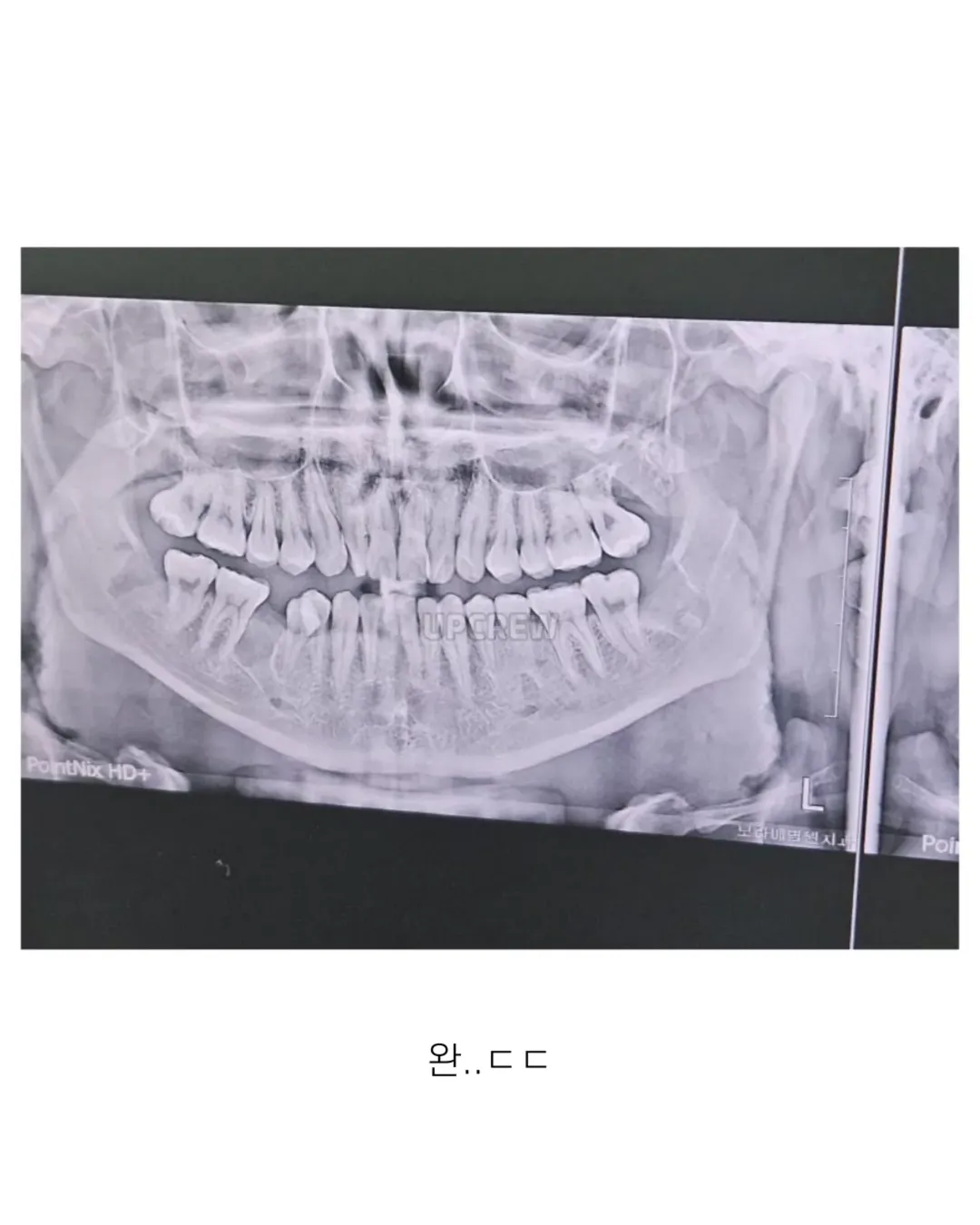 사랑니 갤러리의 특이한 사랑니들 (약혐 주의) | 인스티즈
