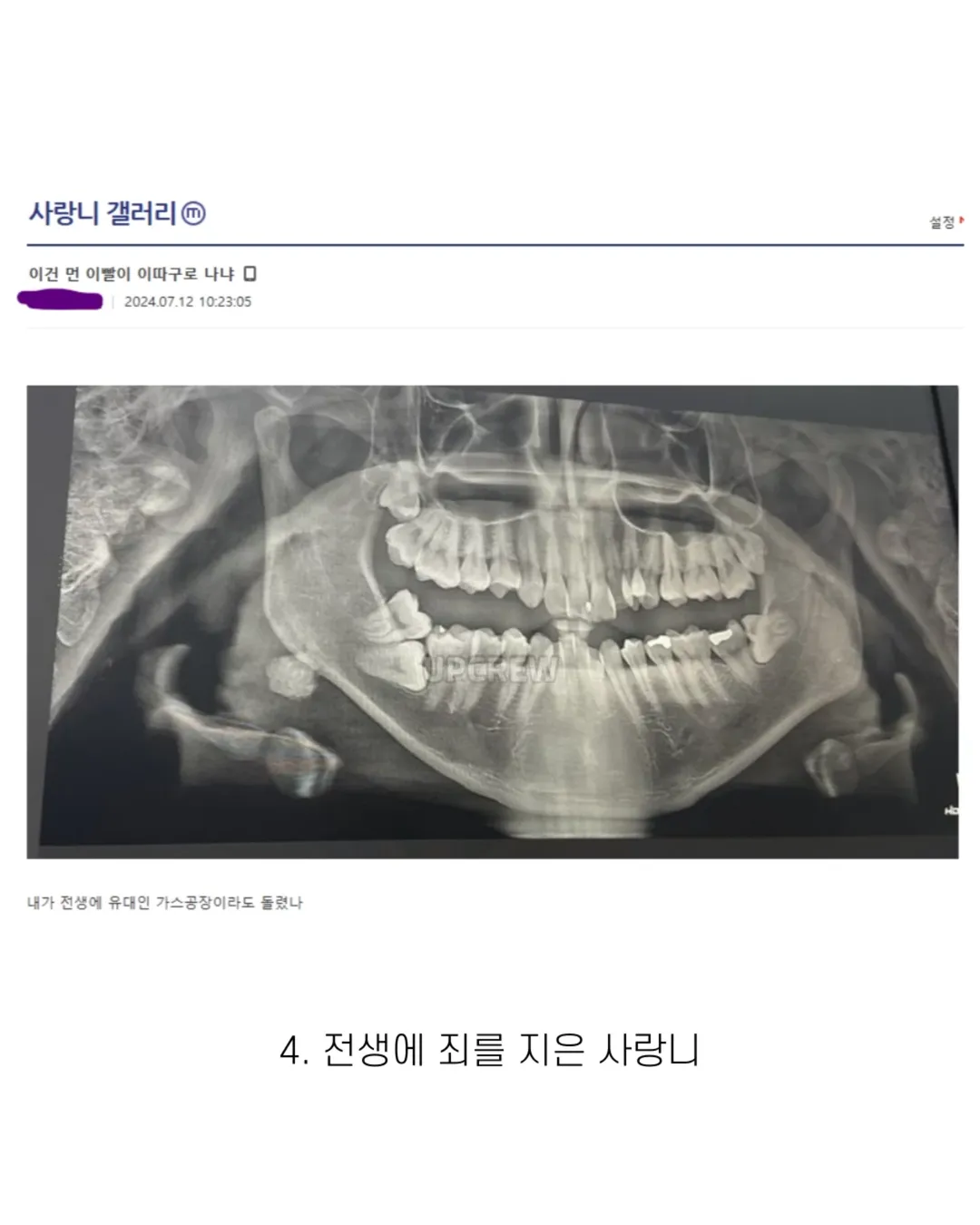 사랑니 갤러리의 특이한 사랑니들 (약혐 주의) | 인스티즈
