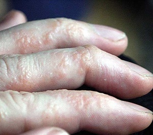 엄청 간지럽고 수포 올라오는 한포진 (약간 징그러울 수 있음 주의ㅠ) | 인스티즈